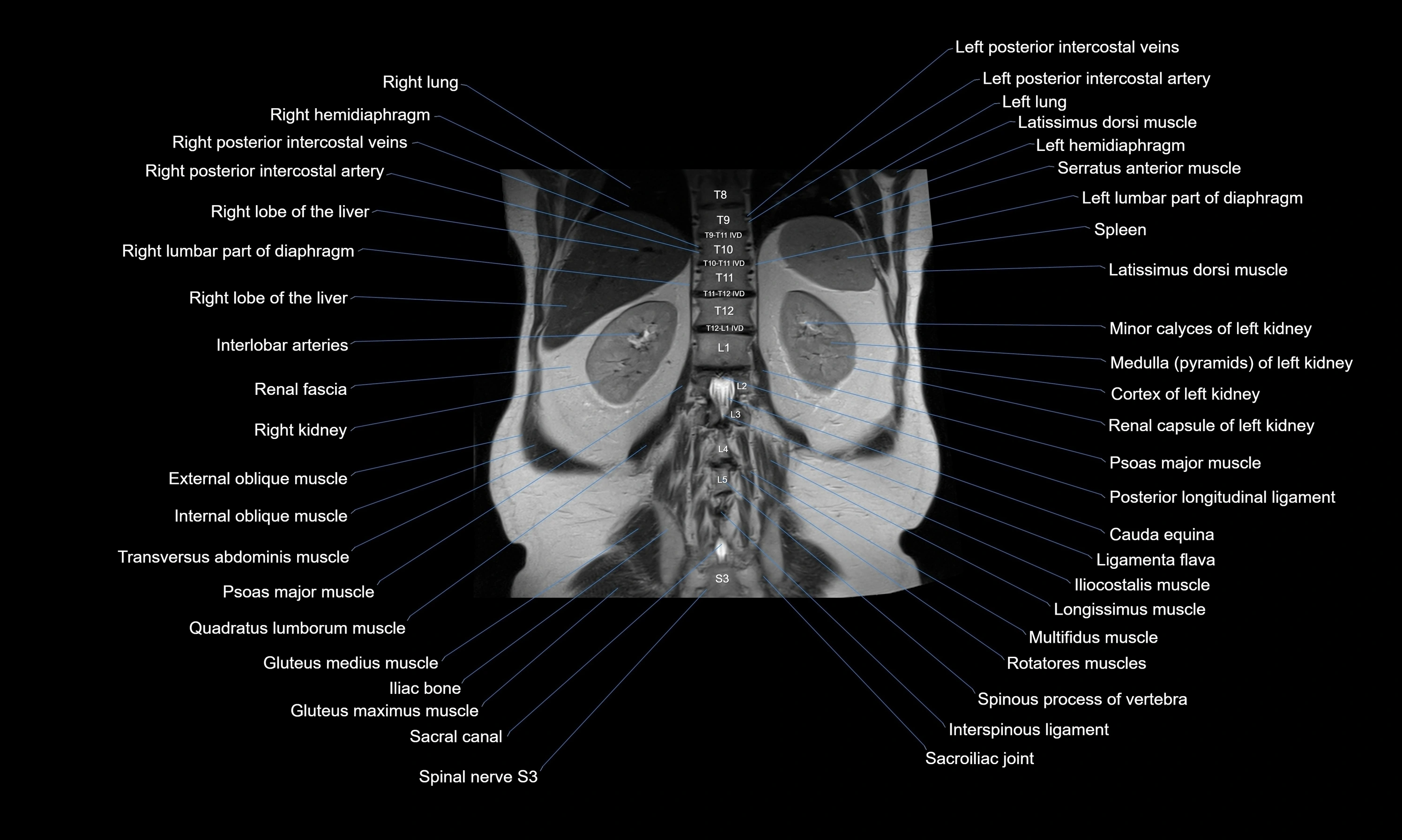 MRI Abdomen axial cross sectional anatomy radiology  image-img-00001-00044.webp